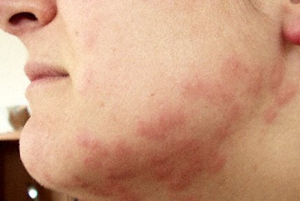 bed bug bites - Bed Bug Treatment in the Greater Memphis Area